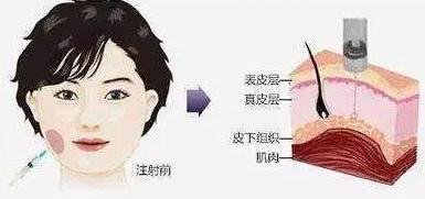注射瘦脸的原理