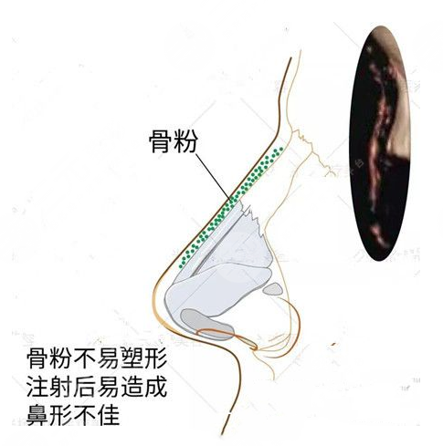 什么是人工骨粉隆鼻