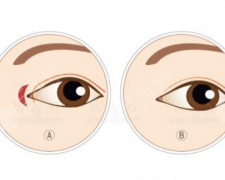 什么人适合开眼尾？特点+注意事项科普，美眼秘籍来袭！