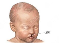 兔唇能完全修复吗？修复科普分享！