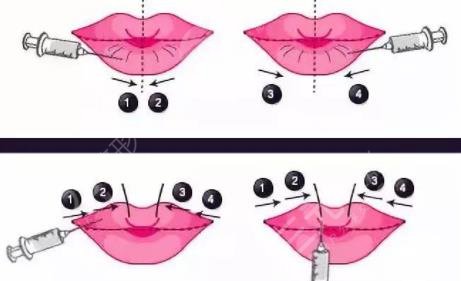 非手术丰唇方法有哪些