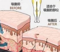 360度环形吸脂具体是什么？怎么做的？后遗症+果图科普干货分享！