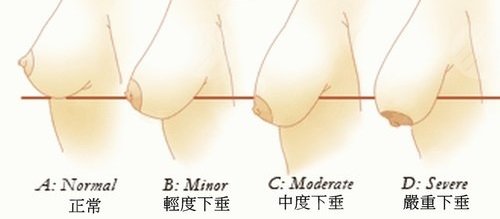 胸部下垂严重程度