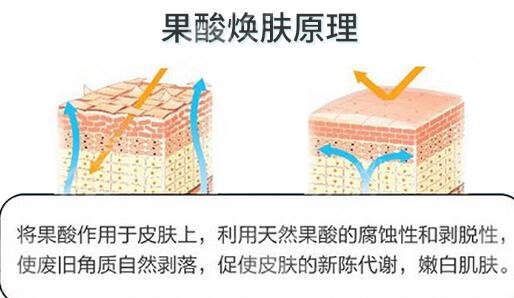  果酸祛痘原理