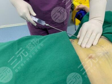 腹部吸脂的费用是多少
