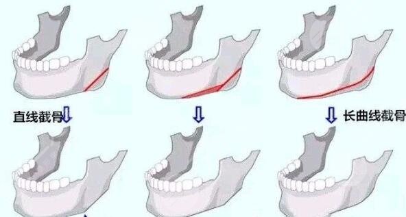 磨骨手术术后注意事项