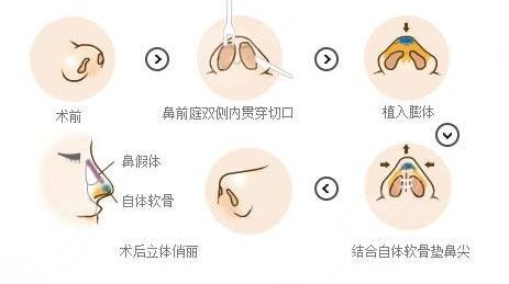 什么是隆鼻手术