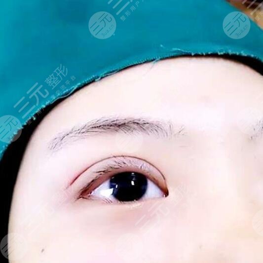 肿眼泡割了双眼皮想死