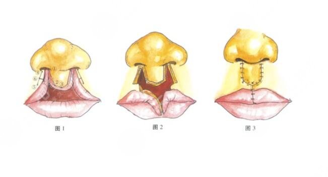 兔唇修复怎么做