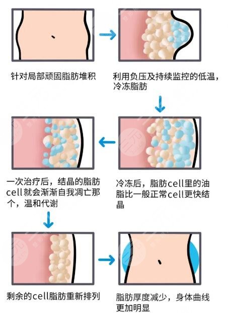有没有必要进行吸脂项目?