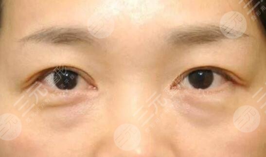 眼袋切除手术能保几年?如何避免眼袋的形成?