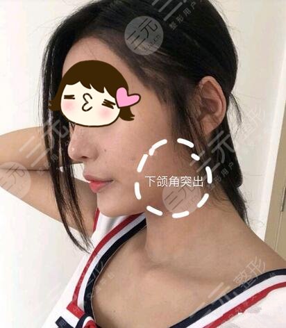 削骨瘦脸手术前需要了解了相关知识
