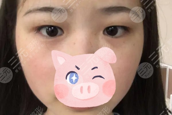 纳米微创双眼皮保持多久