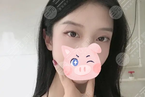 纳米微创双眼皮保持多久