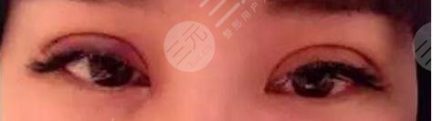  双眼皮过宽