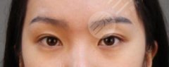 双眼皮失败的八种表现分别有哪些？双眼皮失败的八种图片