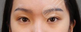 双眼皮不对称