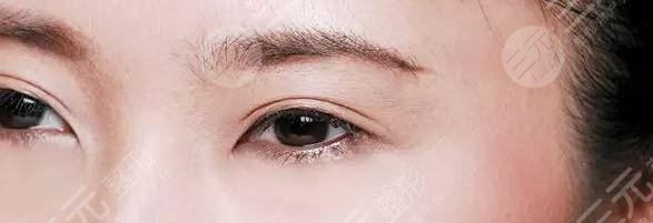  双眼皮过低
