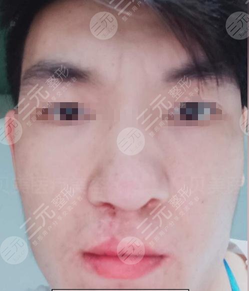 唇裂修复术后半年