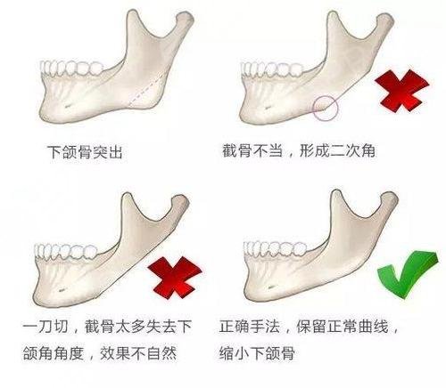 磨骨手术有什么风险和后遗症？