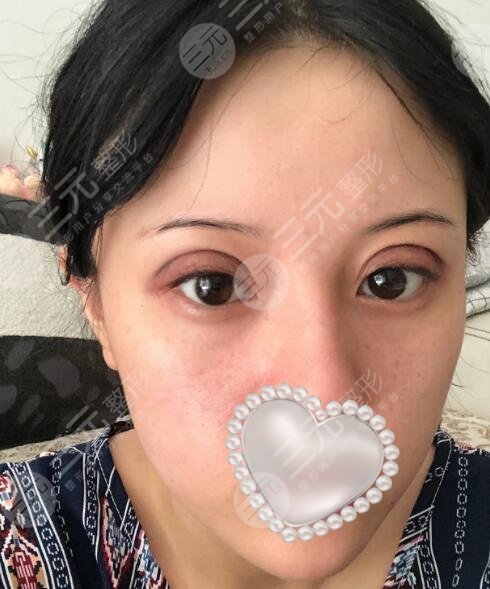 高分子埋线双眼皮案例