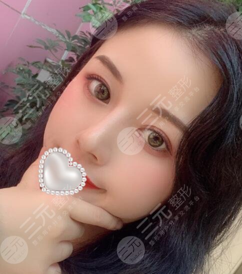 高分子埋线双眼皮案例