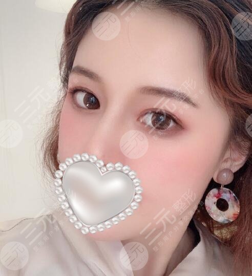 高分子埋线双眼皮案例