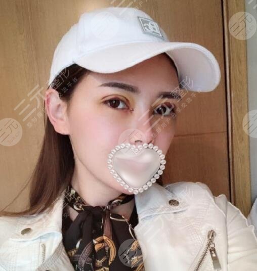 汪立川双眼皮案例