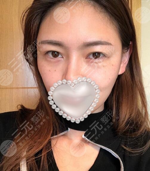 汪立川双眼皮案例