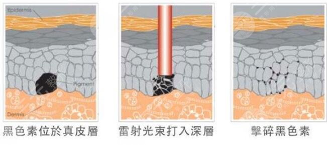 激光祛黄褐斑会越来越严重吗