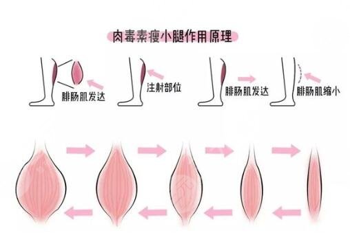 瘦?腿价格与求美者有关　