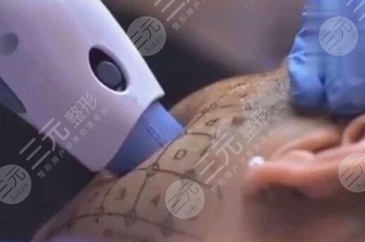 影响热玛吉价格的因素