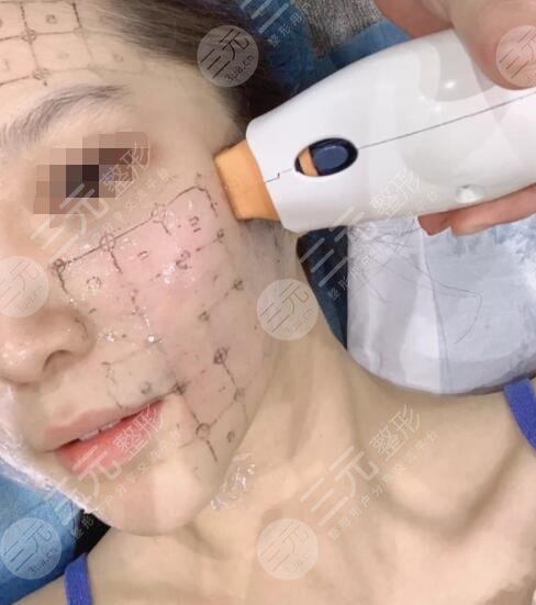 热玛吉多久做一次合适