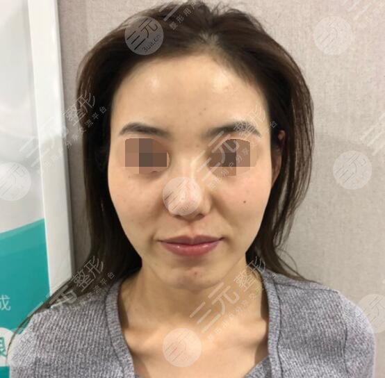 激光祛除黄褐斑的果怎么样?日常保养注意事项