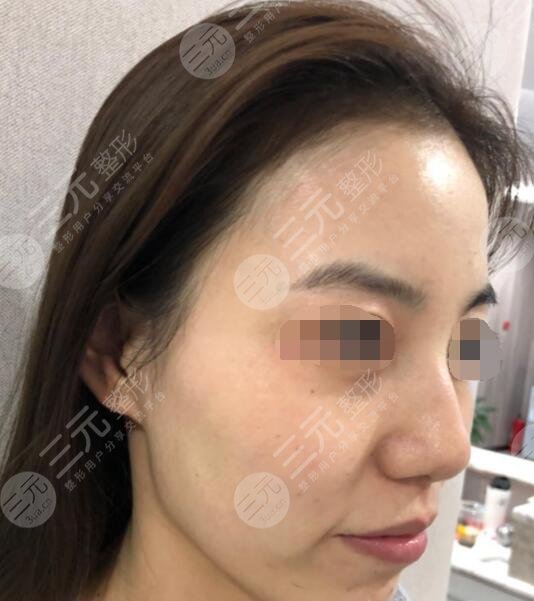 激光祛除黄褐斑的果前