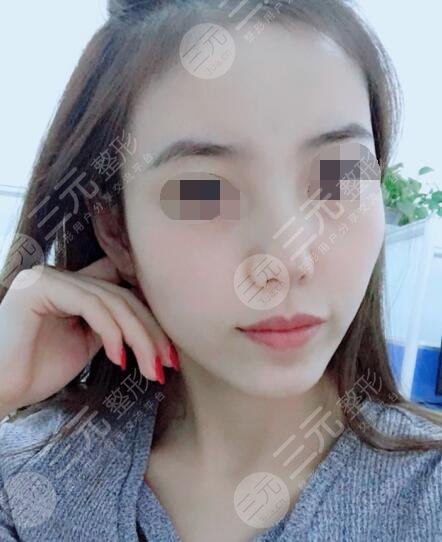 激光祛除黄褐斑的果后