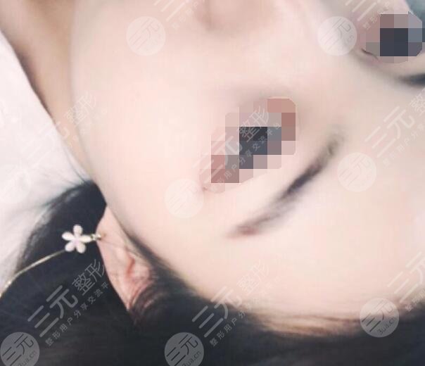 激光祛除黄褐斑的果展示