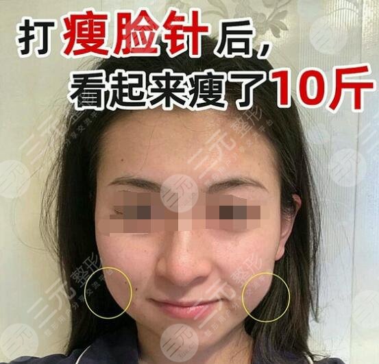 打注射瘦脸术后的注意事项