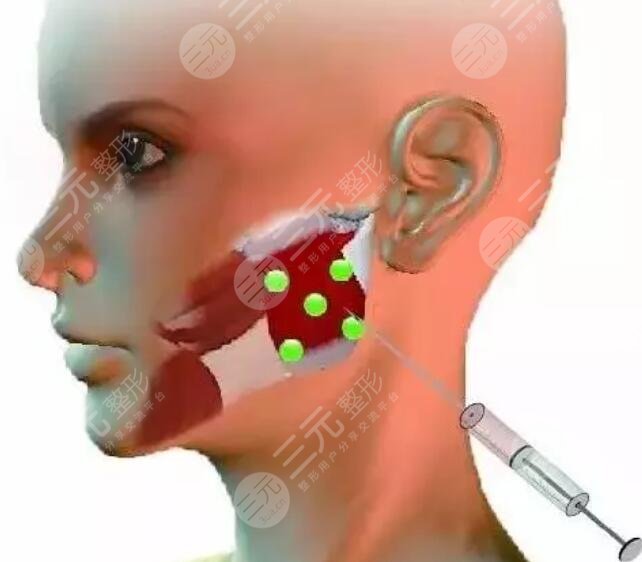 注射瘦脸的价格