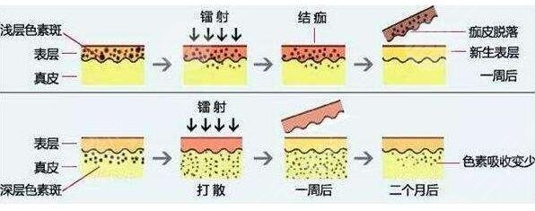 激光去黄褐斑注意事项