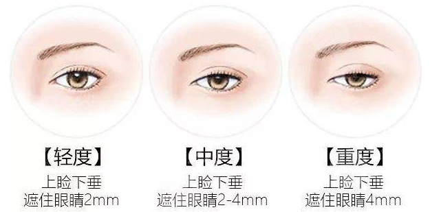 眼皮松弛怎么办?爱美者一定要引起足够的重视!