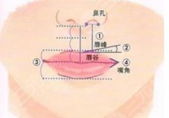 胶原蛋白丰唇果怎么样？注意事项具体有哪些？