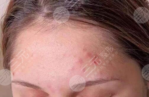 去痘印疤痕有的方法都有哪些？小技巧都学起来！
