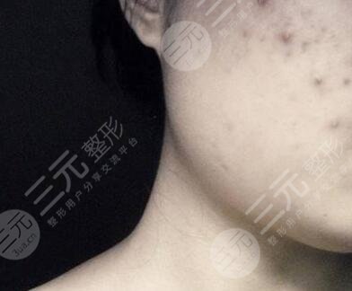 黑色痘疤