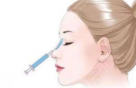 注射隆鼻有几种方法