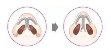 盘点几种隆鼻的材料