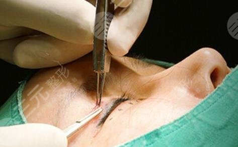 什么是韩式微创双眼皮