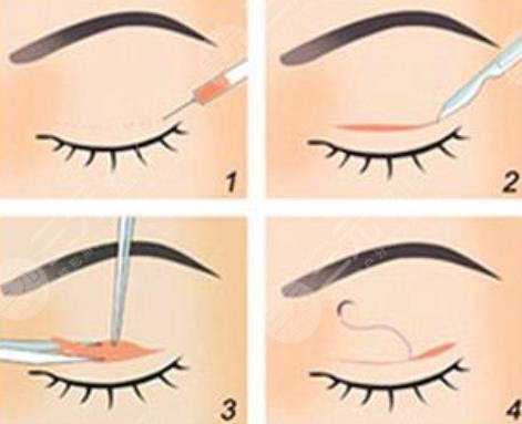 韩式微创双眼皮可以保持多少年