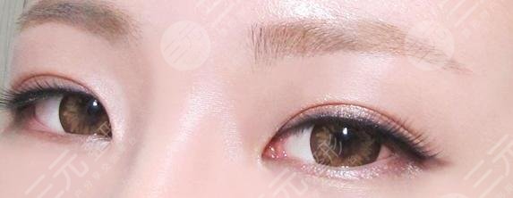 韩式微创双眼皮的优势有哪些