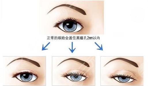 眼睑下垂手术能长时间吗